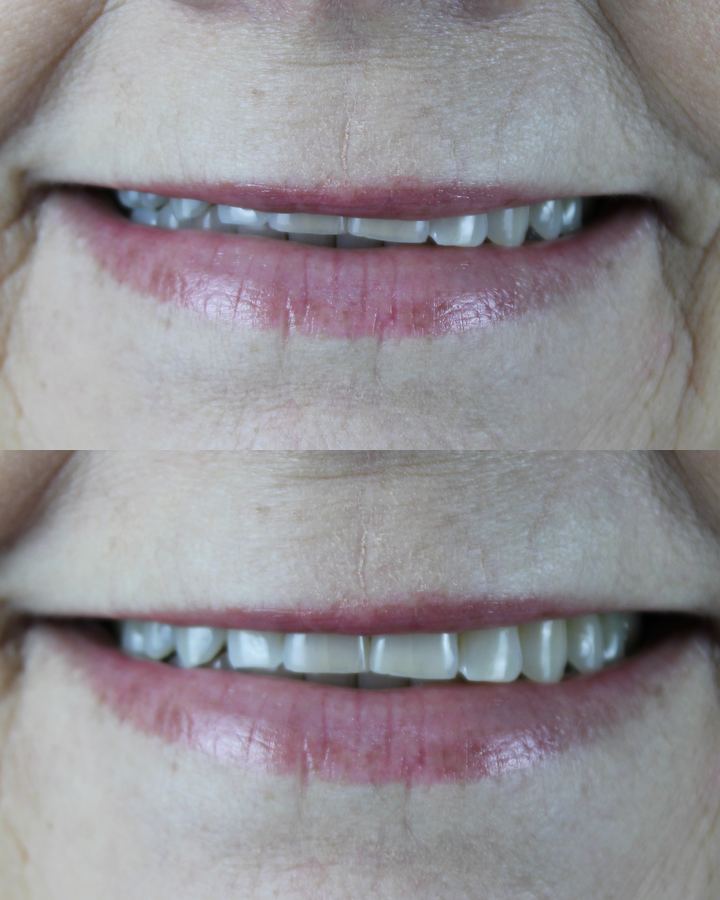 Antes e depois: Implantes dentários
