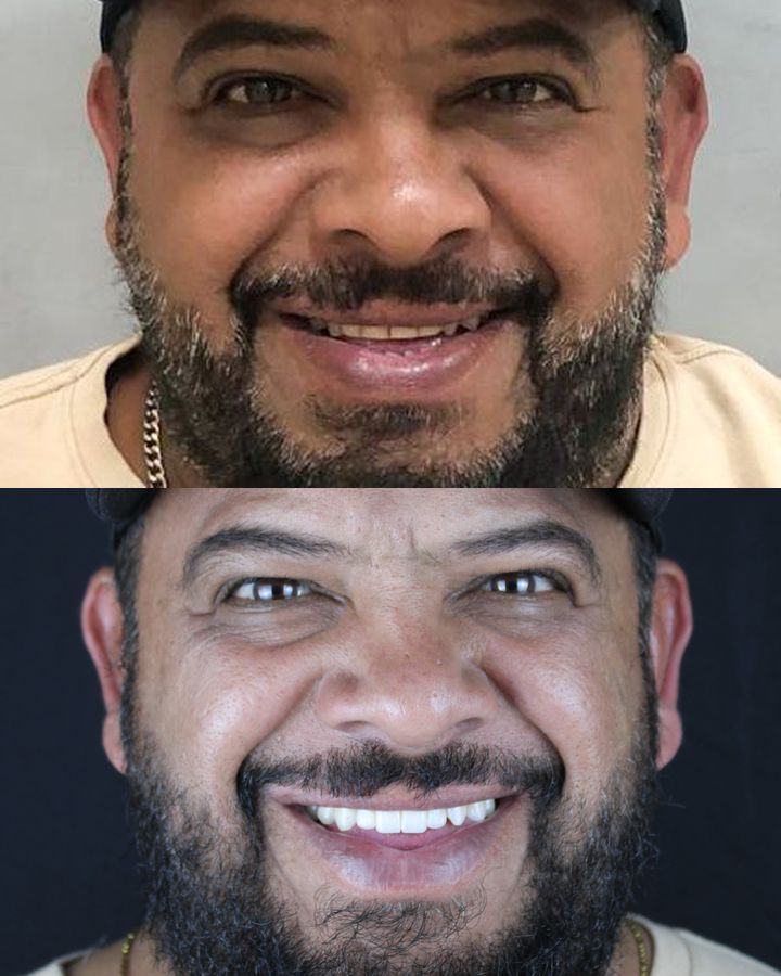 Antes e depois: Implante dentário