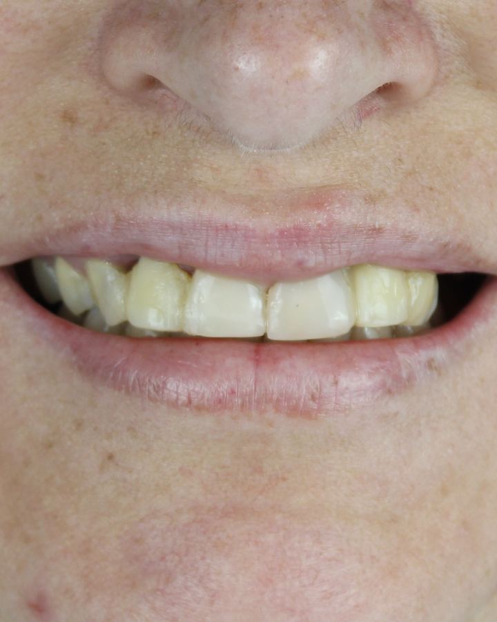 Resultado: Implante dentário