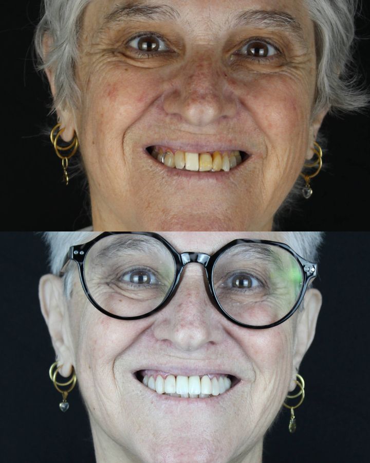 Antes e depois: Implante e facetas