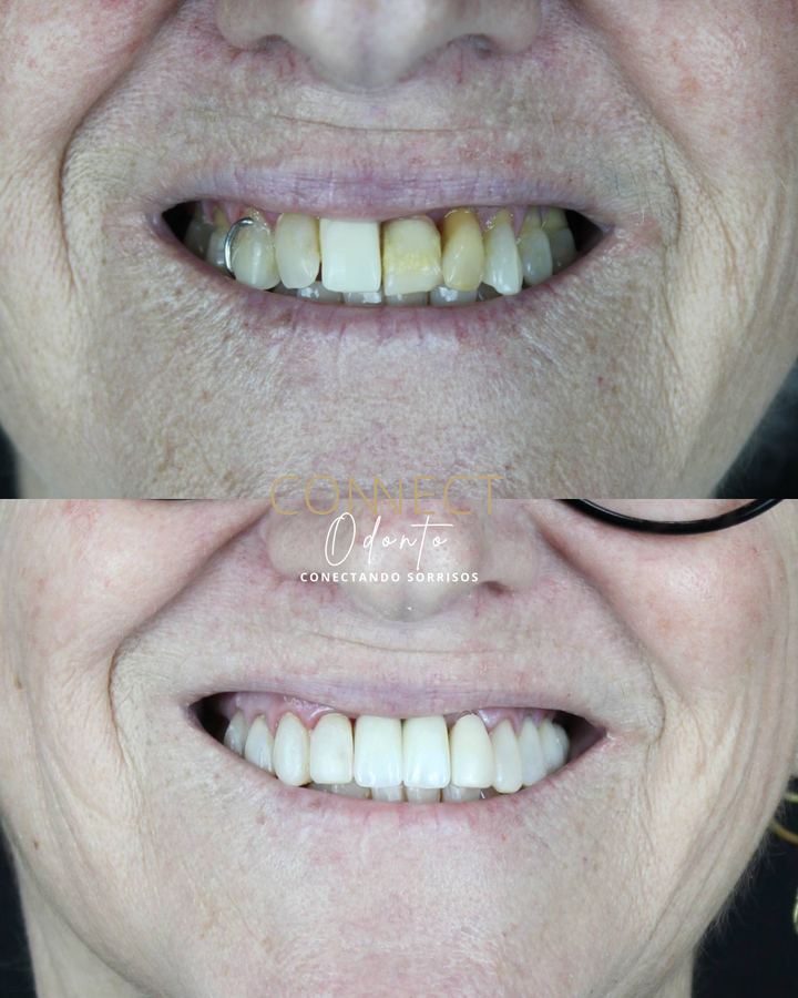 Antes e depois: Implante e facetas