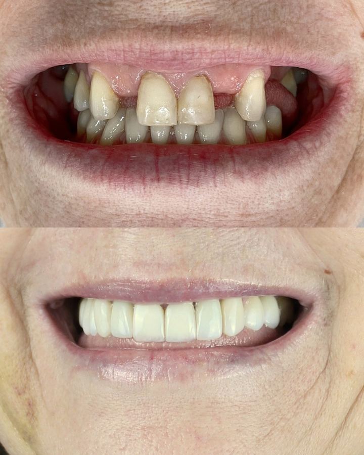 Antes e depois: Implante dentário