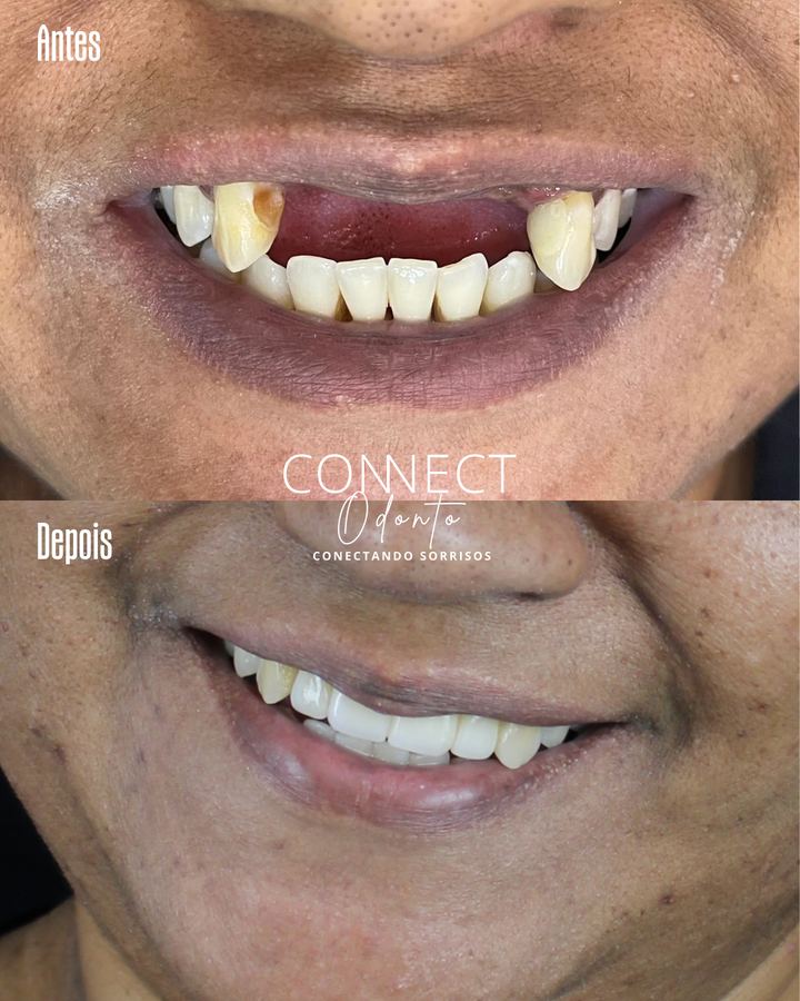 Antes e depois: Implante dentário