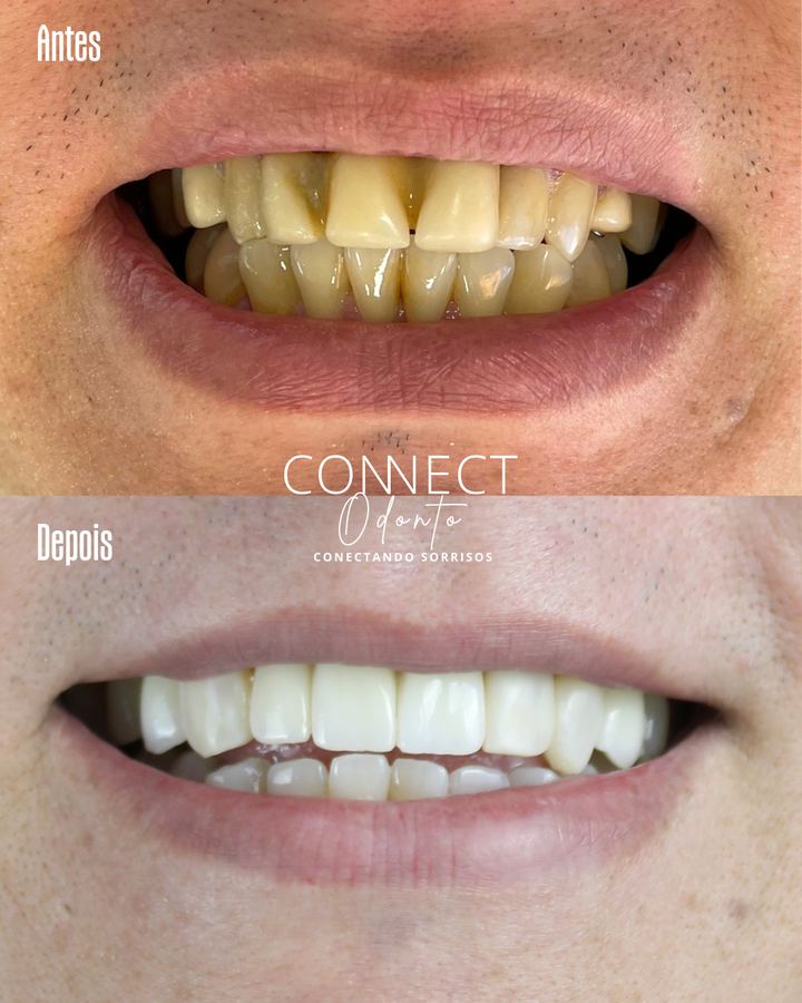 Antes e depois: Implante e facetas